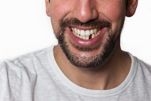 Dental Implants, bridges and more tooth replacement options in West Edmonton