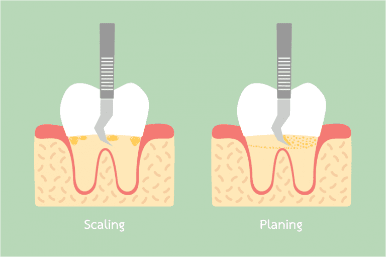 How Dental Scaling and Root Planing Can Prevent Gum Disease Lewis