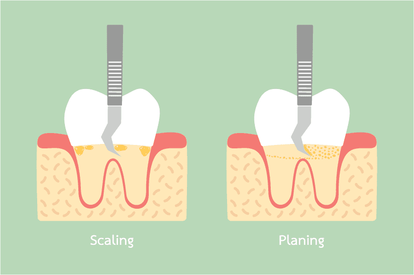 differences-in-dental-scaling-and-root-planing