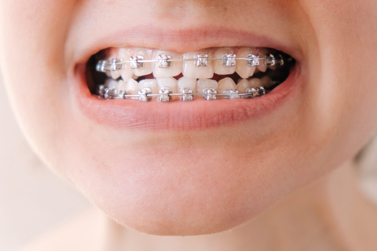 Female patient showing orthodontic braces close up
