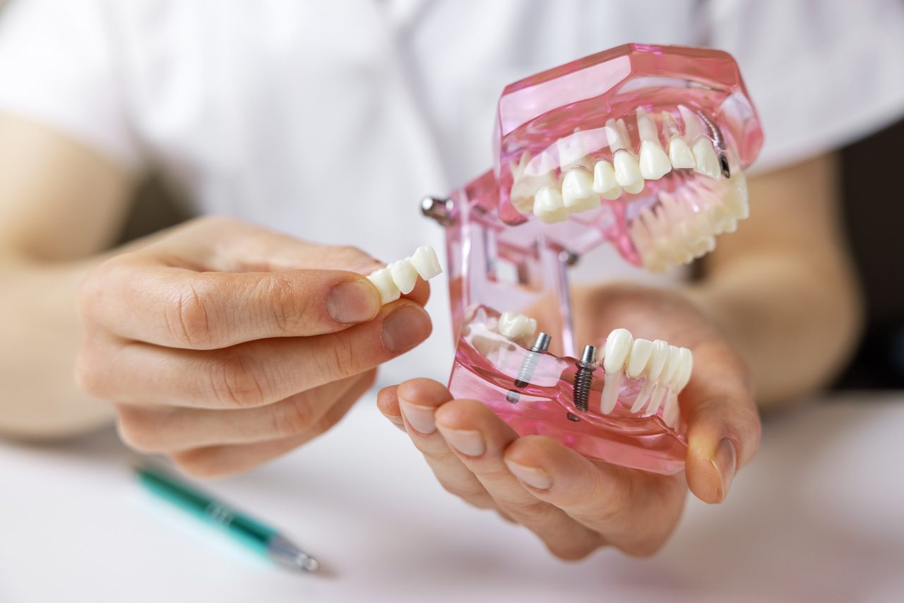 implantologist showing dental bridge on tooth jaw model