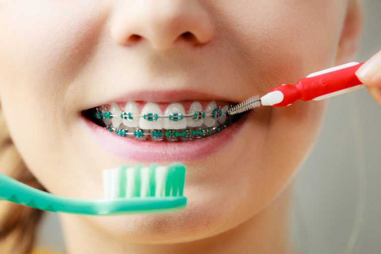 Everything You Need To Know About Brushing and Flossing With Braces