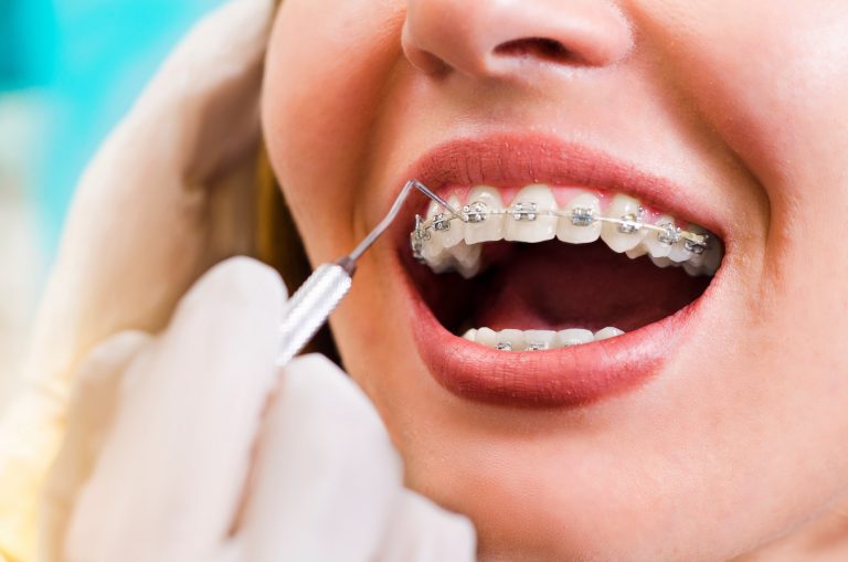 How much do braces cost in Edmonton Area?