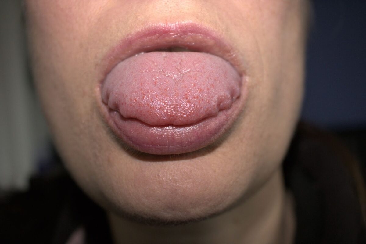 What does a scalloped tongue mean
